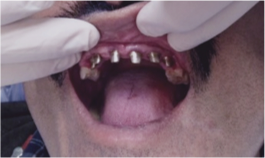 Missing Teeth: Dental Implants | Before & After