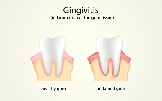 Gum Disease | Symptoms & Treatments of Gingivitis - Greenspoint Dental – Houston Dentist