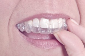 invisalign fits perfectly to womens teeth