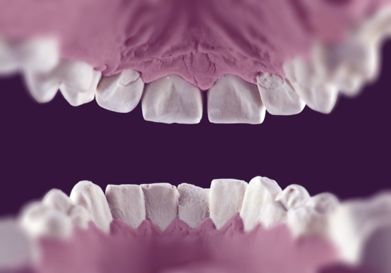 Improve Your Smile | Full Mouth Rehabilitation Procedure
