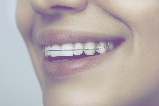 Tooth Repair & Restoration | Best Houston Dentist