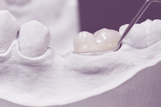 Tooth Decaying Procedures for Weak Teeth | Inlays & Onlays - Greenspoint Dental – Houston Dentist