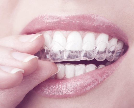 Teeth Whitening Dentist Specials | Discounts & Sales