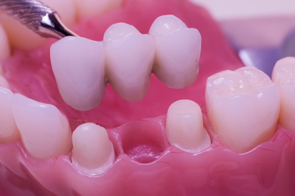 The Types and Benefits of Dental Bridges