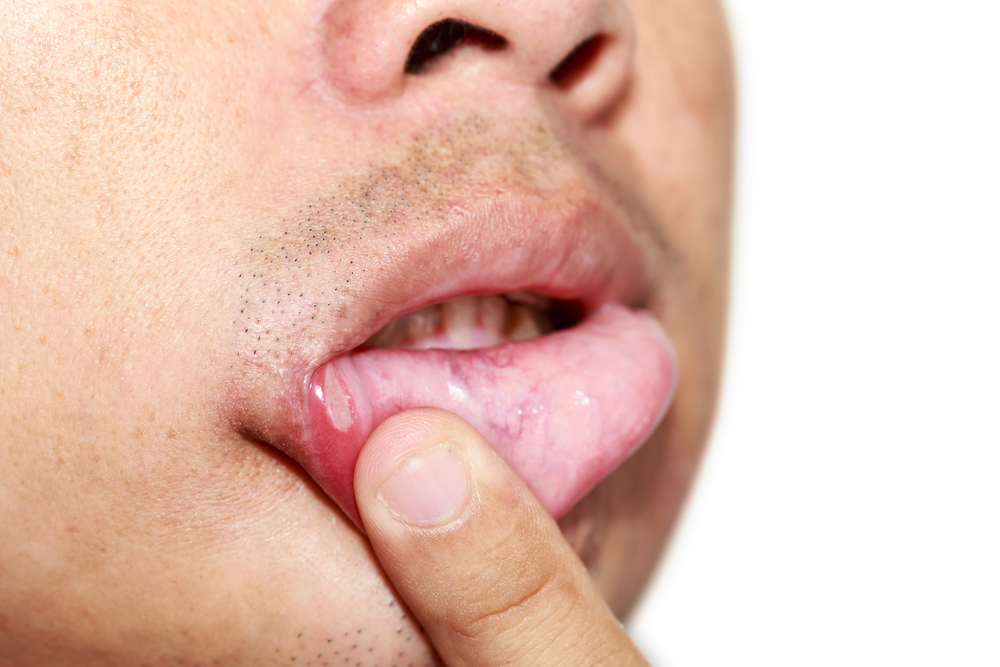 Canker Sores vs. Cold Sores: What’s The Difference?