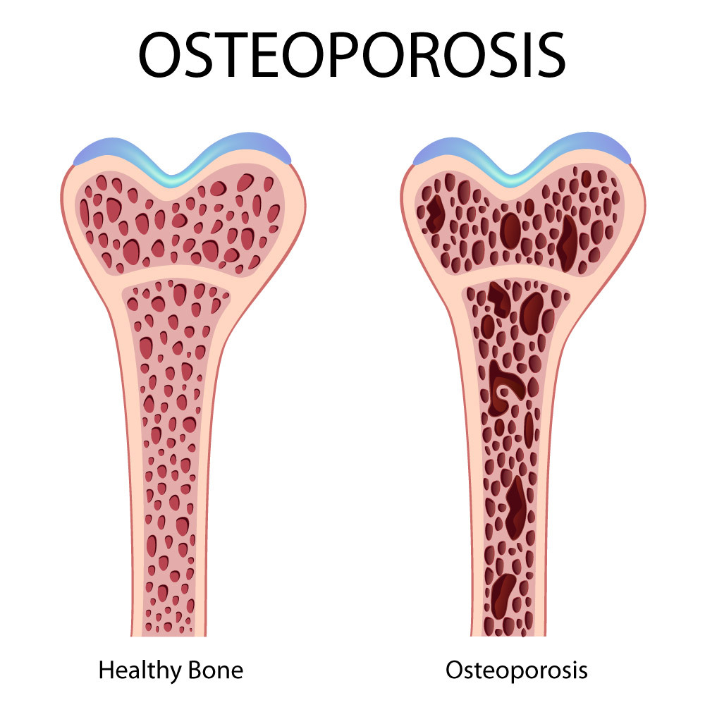 Illustration of osteoporosis, showing a healthy bone on the left and a bone with osteoporosis on the right that has much less density shown by darker and bigger holes