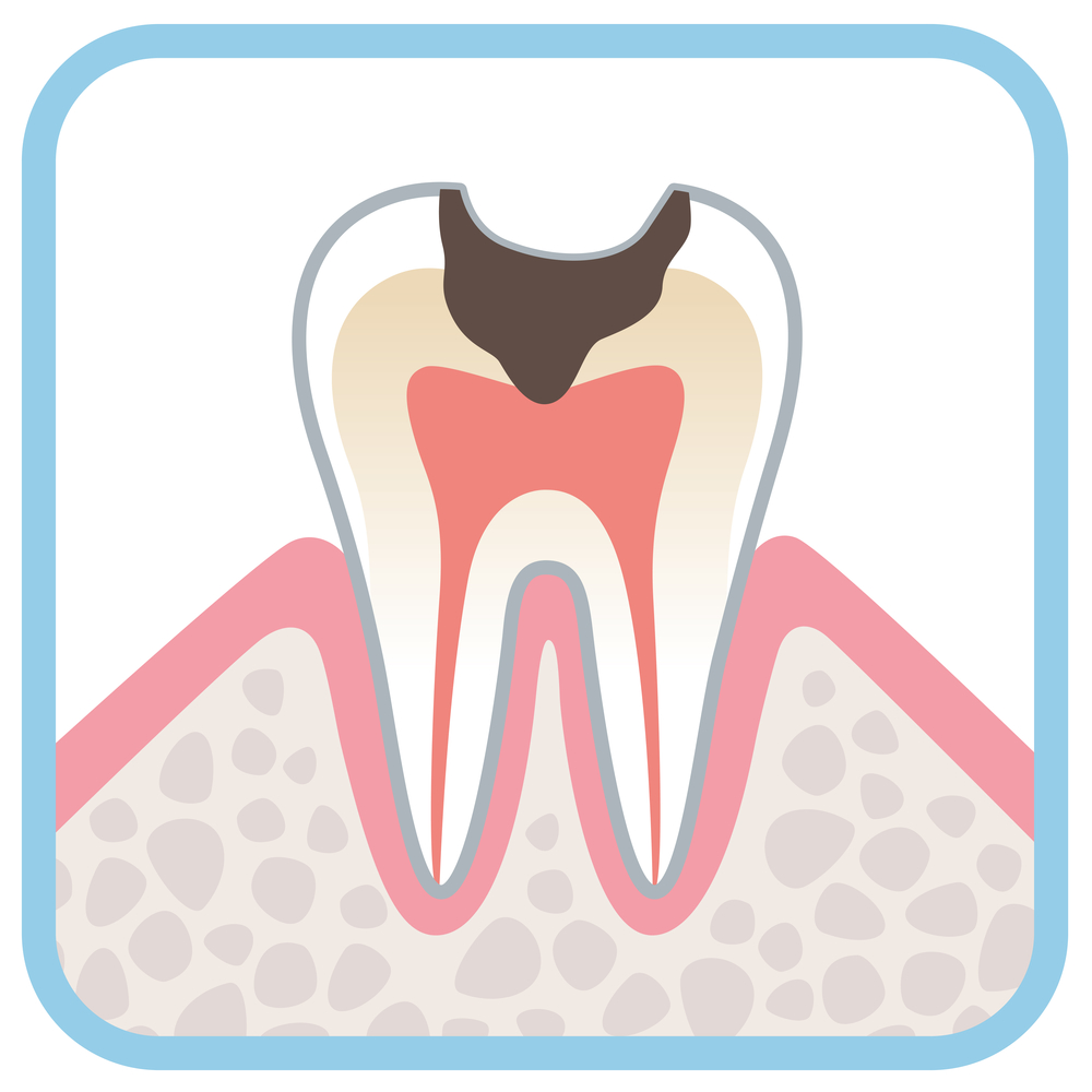 Illustration of a tooth with decay in crown of tooth, through the enamel and dentin to the pulp, sitting in gums