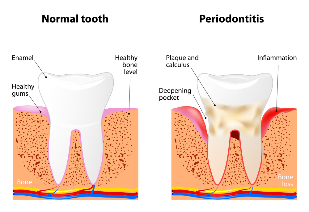 Illustration showing normal tooth versus tooth with periodontitis (gum disease); shows healthy gums versus deepening pocket, enamel versus plaque and calculus, healthy bone level versus inflammation, and bone versus bone loss