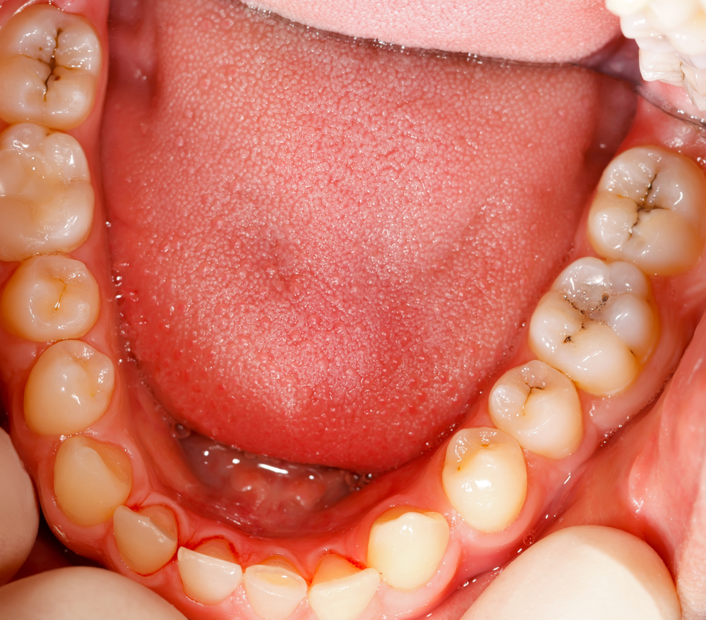 Picutre of person's bottom row of teeth with cavities in the back teeth