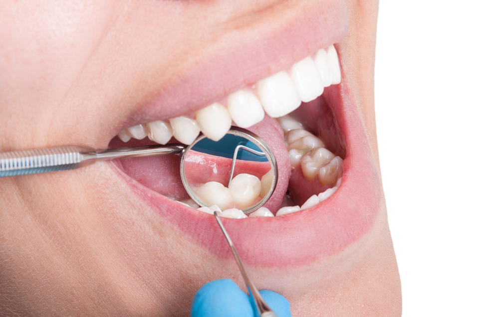 Close up of dentist looking at inside of woman's lower teeth with mirror and metal tootl