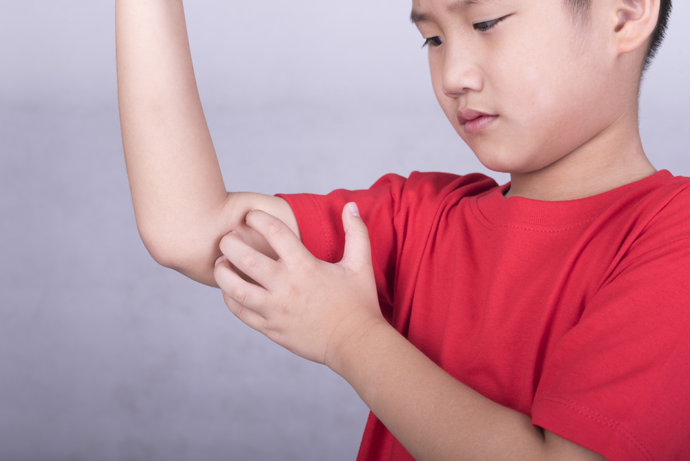 Boy in red shirt itching bug bite on arm