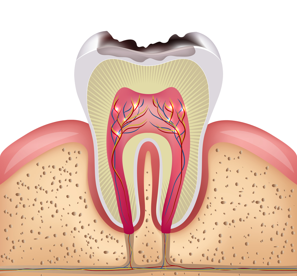 Illustration of cavity in a tooth showing all three layers of a tooth and how the tooth sits in the gums