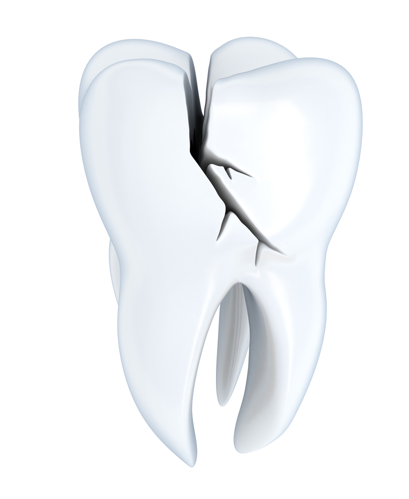 Illustration of a deep crack/fracture in tooth