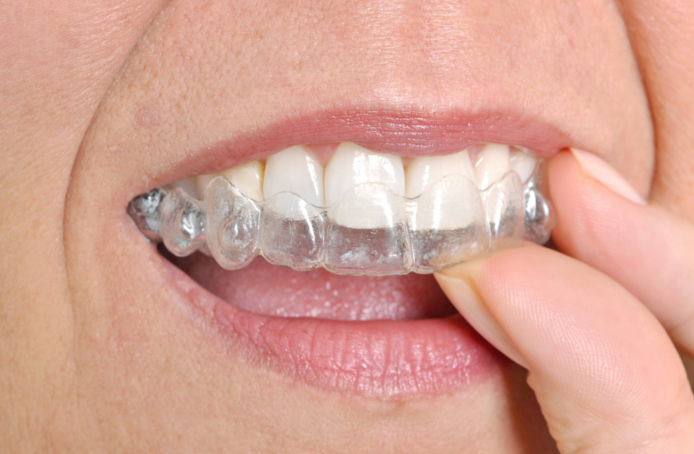 Close up of woman putting Invisalign trays on her teeth