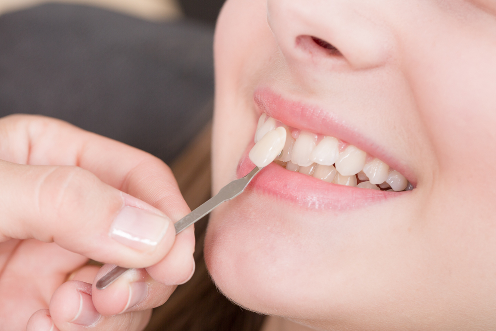Dentist placing dental veneer on woman's tooth