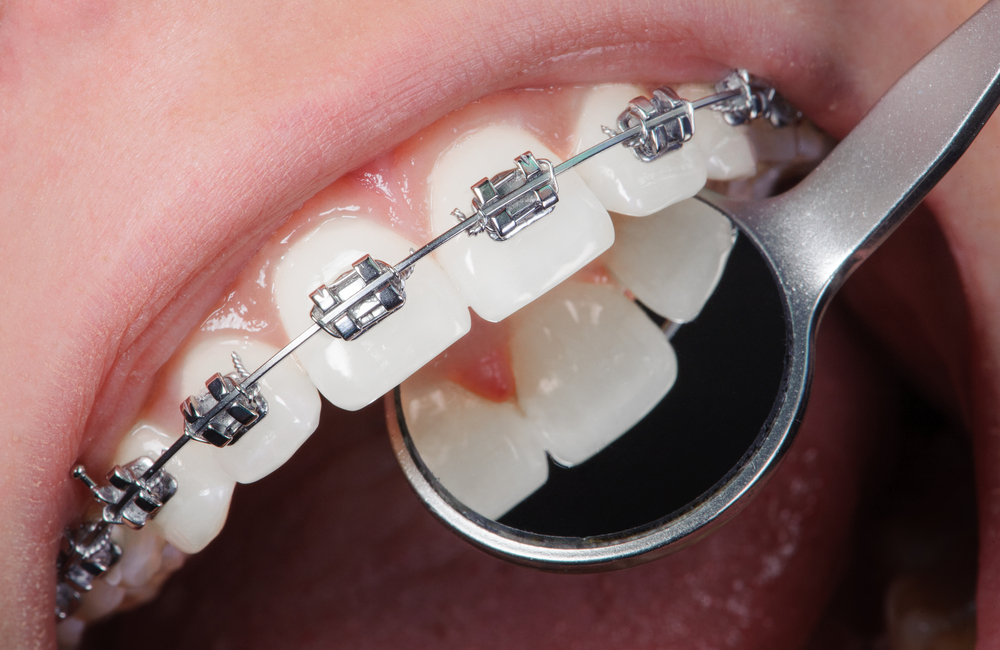 Close up of dentist looking at back of person's white teeth with metal braces on the front of the teeth