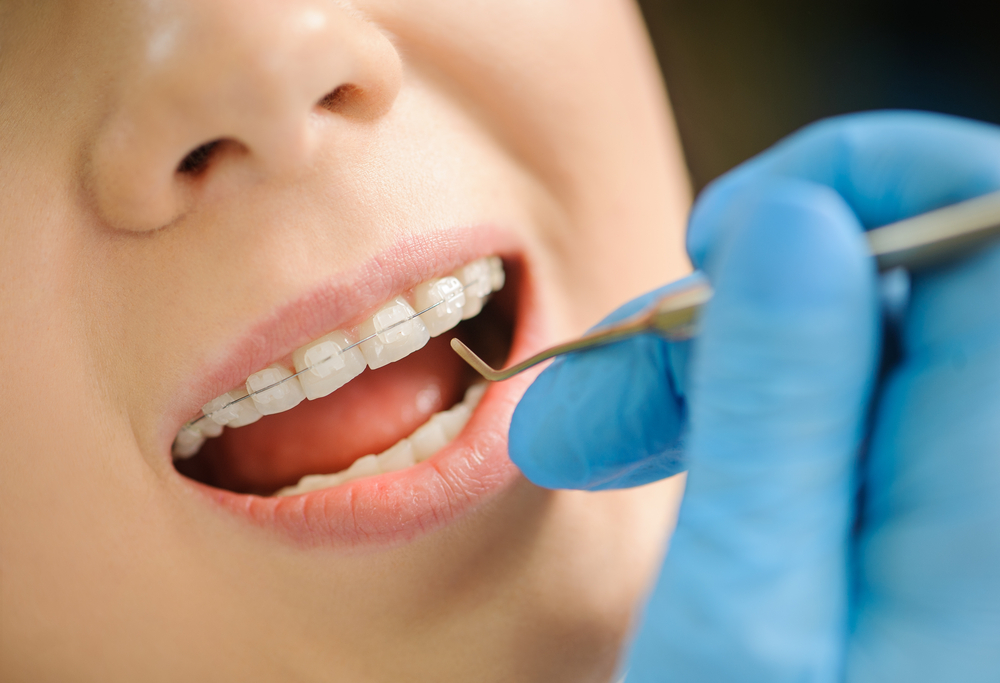 Dentist examining woman's clear ceramic braces with metal dental tool