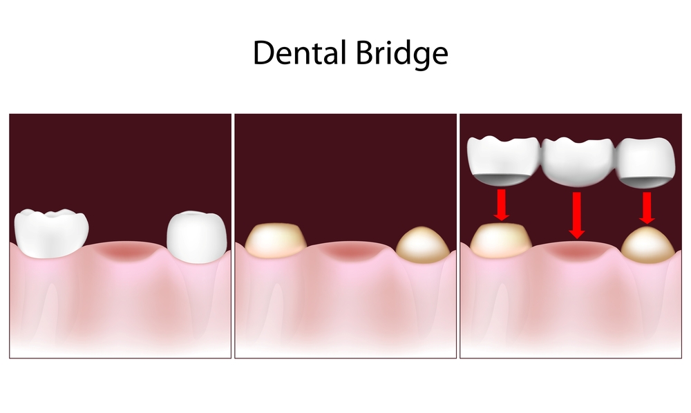 Illustration of 3 phases of receiving a dental bridge with two caps and one false tooth in between them