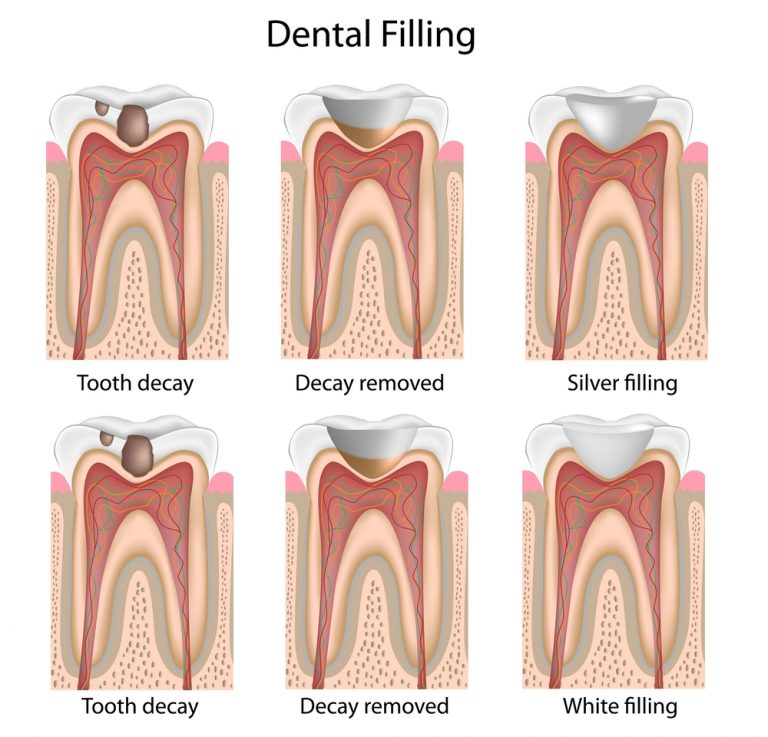 3 Things that Can Damage Your Dental Fillings - Greenspoint Dental