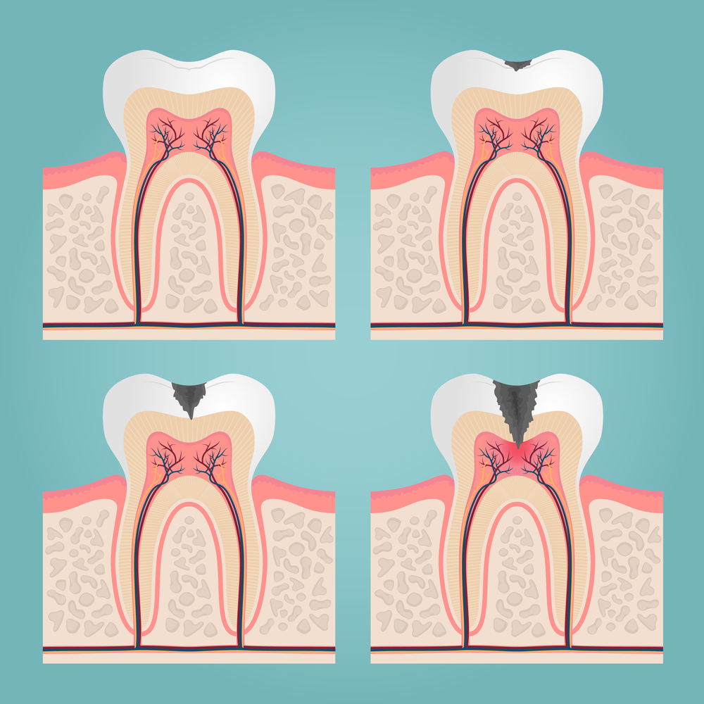 Illustration of phases of tooth decay through enamel dentin and pulp