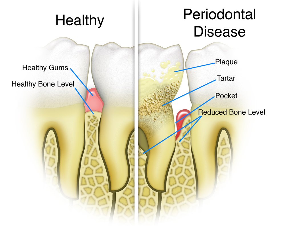 Illustration comparing a mouth with healthy teeth to a mouth with teeth with plaque and tartar and periodontal disease