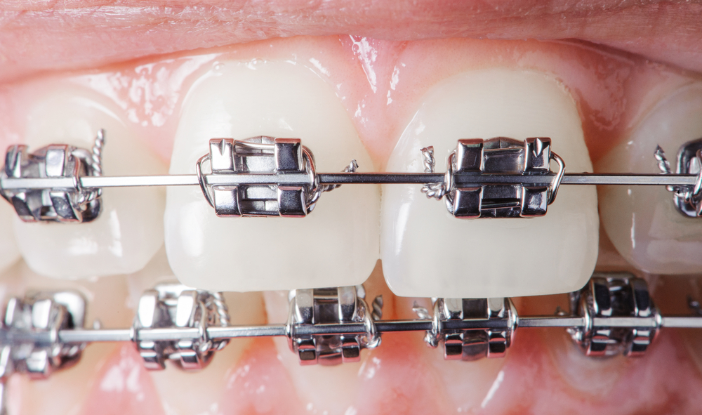 Close up of metal braces on both sets of teeth