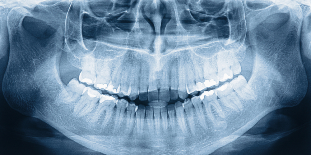 Dental X-ray of person's mouth