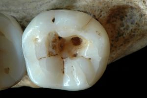 14000 year old cavities
