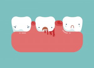illustration of sad 3 teeth depicting gingivitis