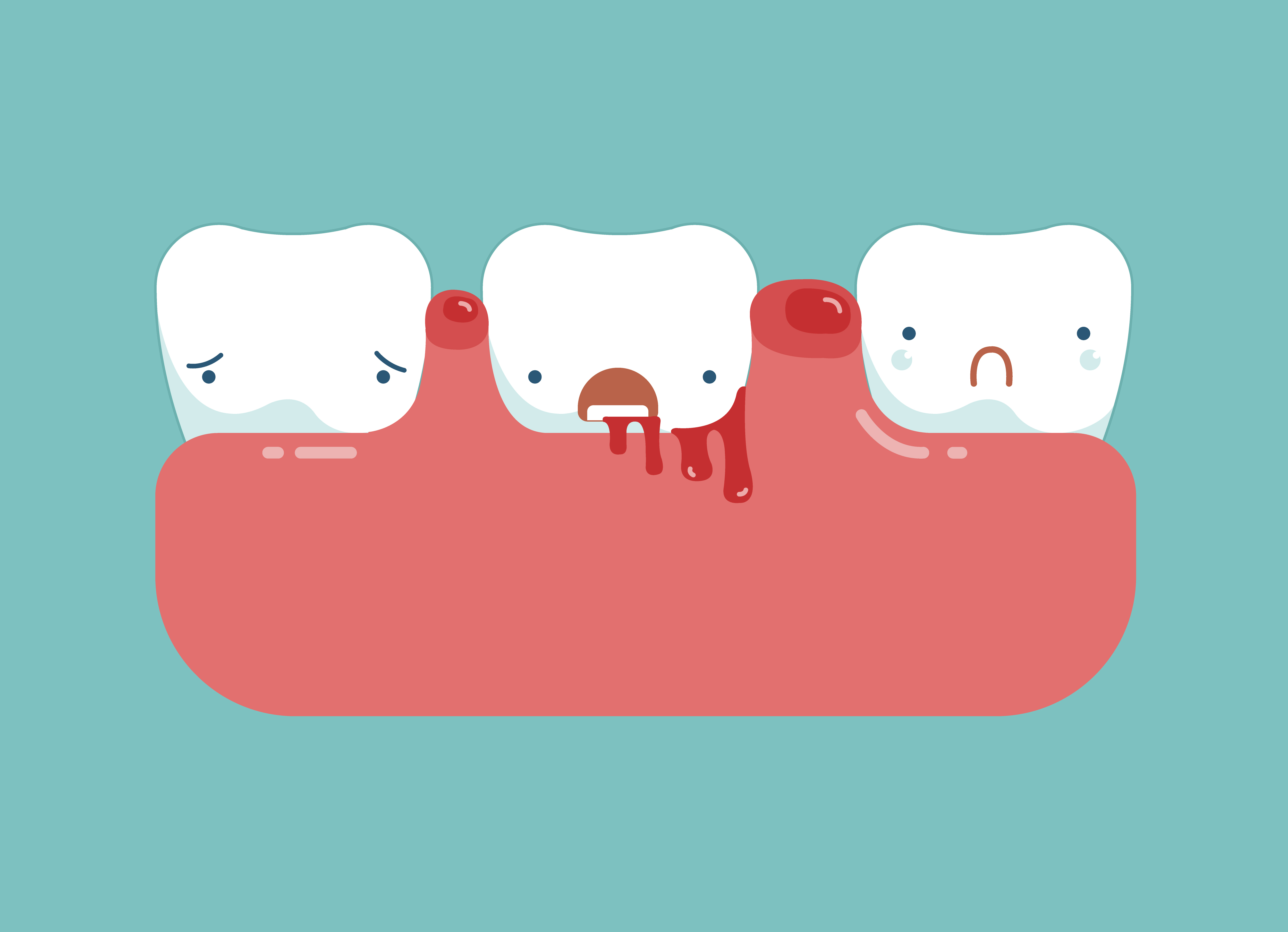 illustration of sad 3 teeth depicting pregnancy gingivitis 