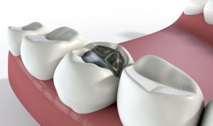 Cavity-in-tooth