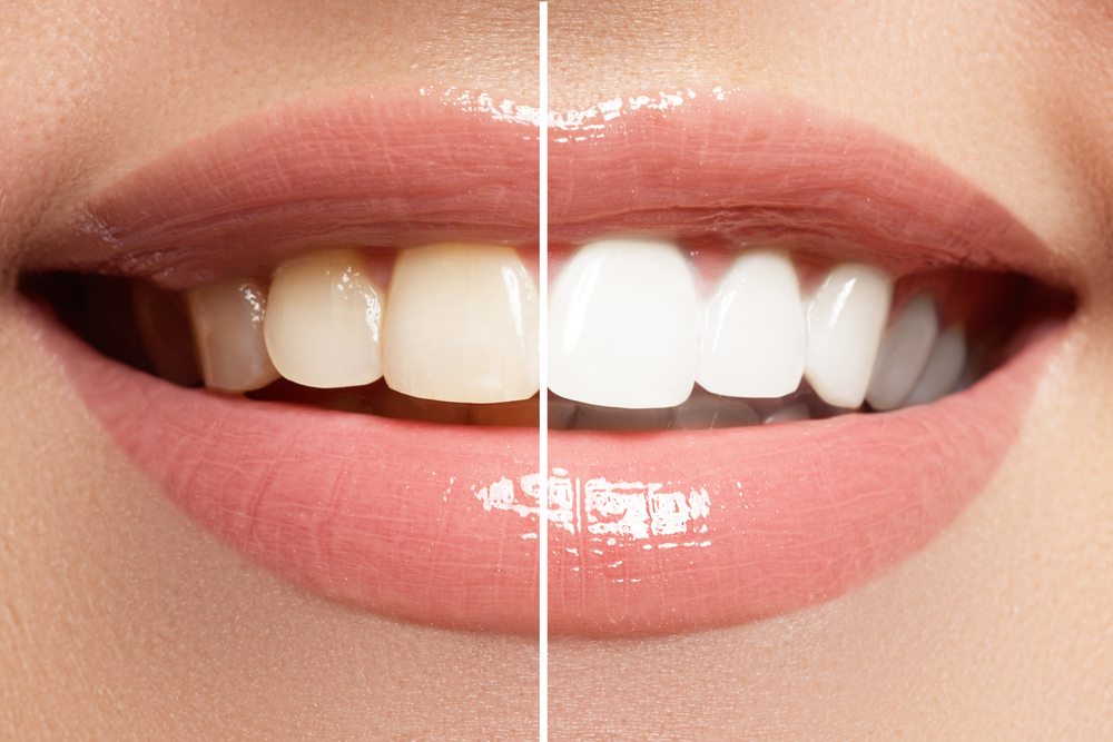 before and after of teeth whitening, one side of the smile is discolored but the other is white