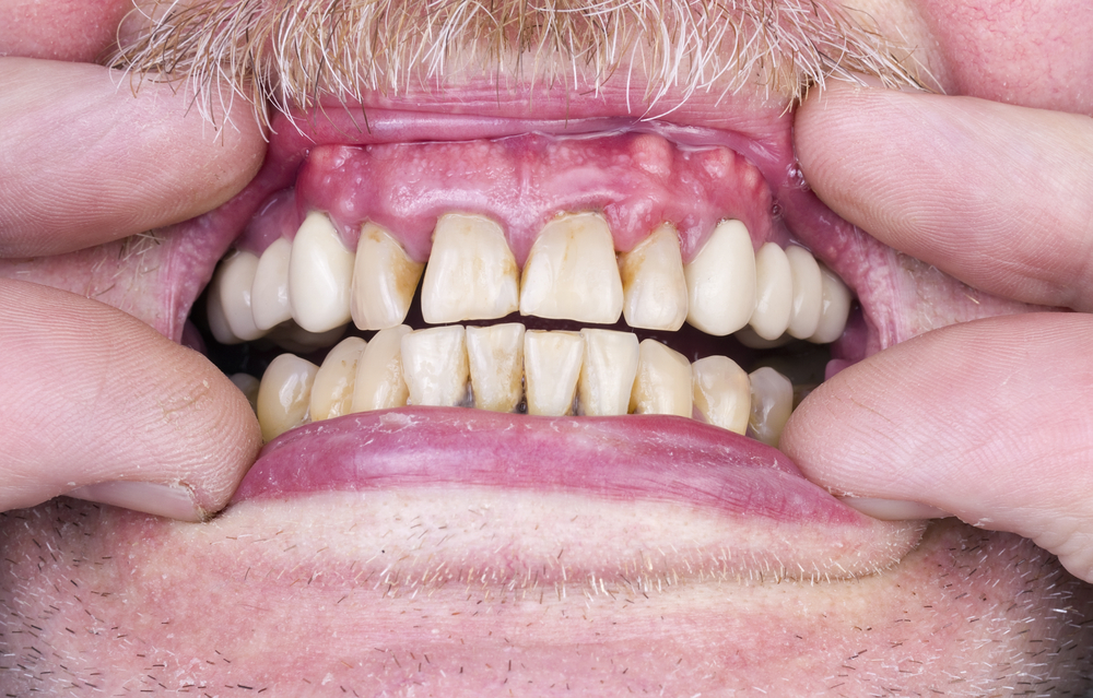 image showing unevenly discolored teeth