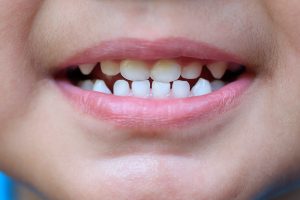 a baby's mouth with a milk tooth