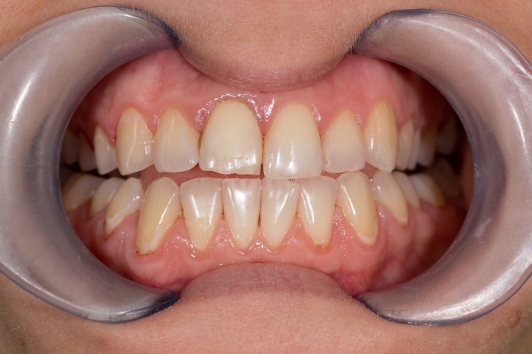 Gum Contouring FAQ Greenspoint Dental Houston Dentist