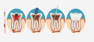 illustration of a root canal process