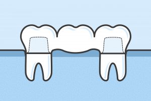 Teeth with dental bridge vector medical illustration in flat linework style- missing front tooth