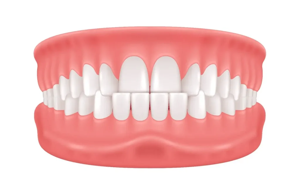 class 3 malocclusion