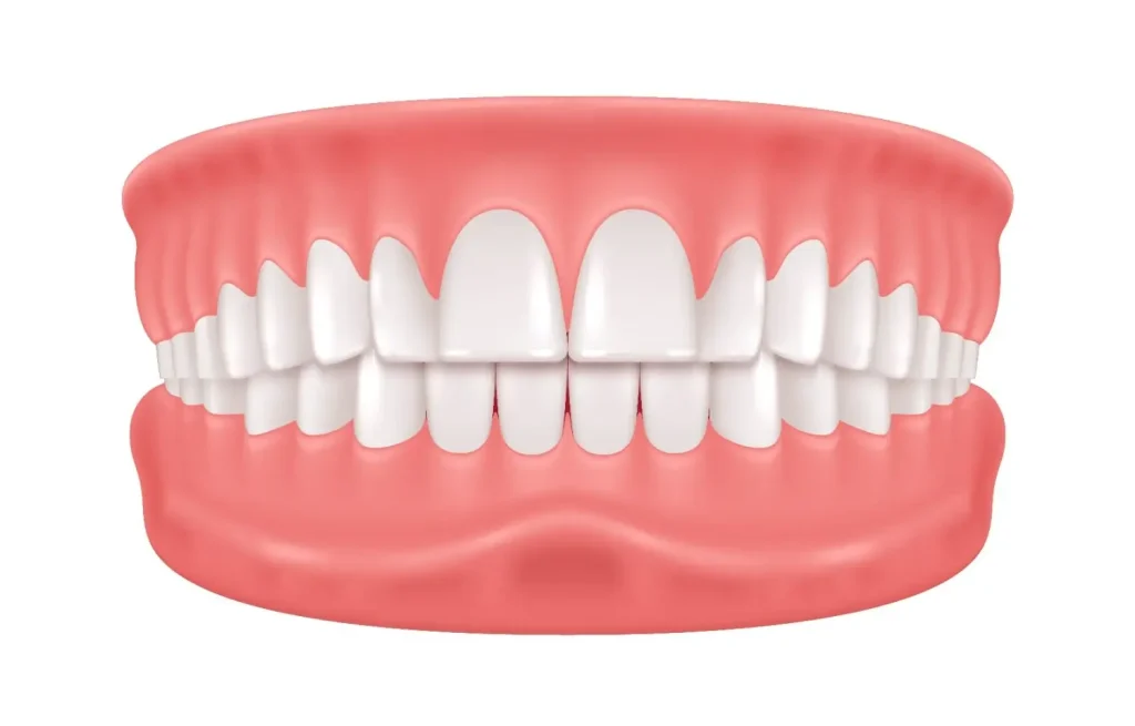 class 2 malocclusion