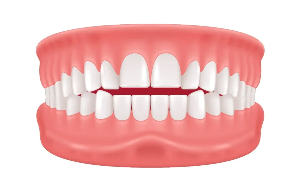 class 1 malocclusion