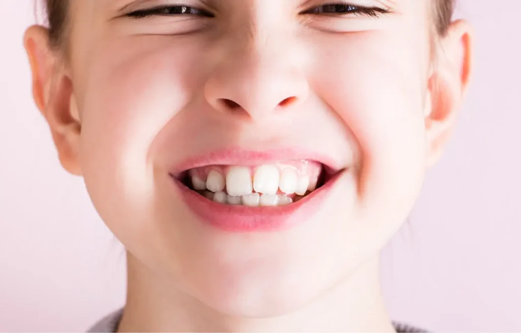 smiling child with class 2 malocclusion