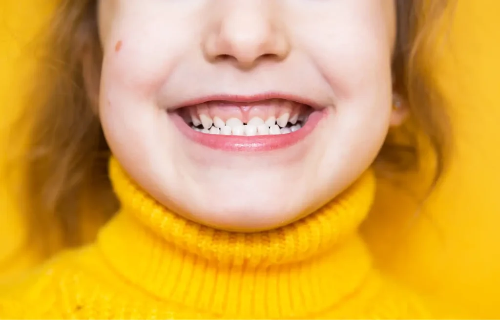 smiling girl with malocclusion