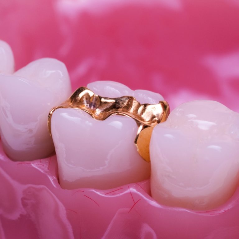 Dental Crown Coverage