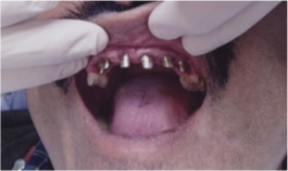 Dental Implant Specialists in Houston, TX | Greenspoint Dental