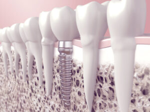 dental implants houston tx