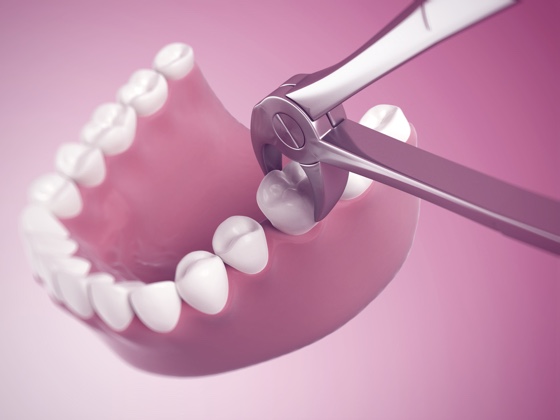 Teeth Extraction, Houston, TX | Safe Wisdom Teeth Removal - Greenspoint Dental – Houston Dentist