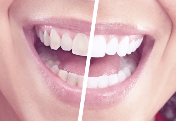 Book Zoom Teeth Whitening in Houston at only $395