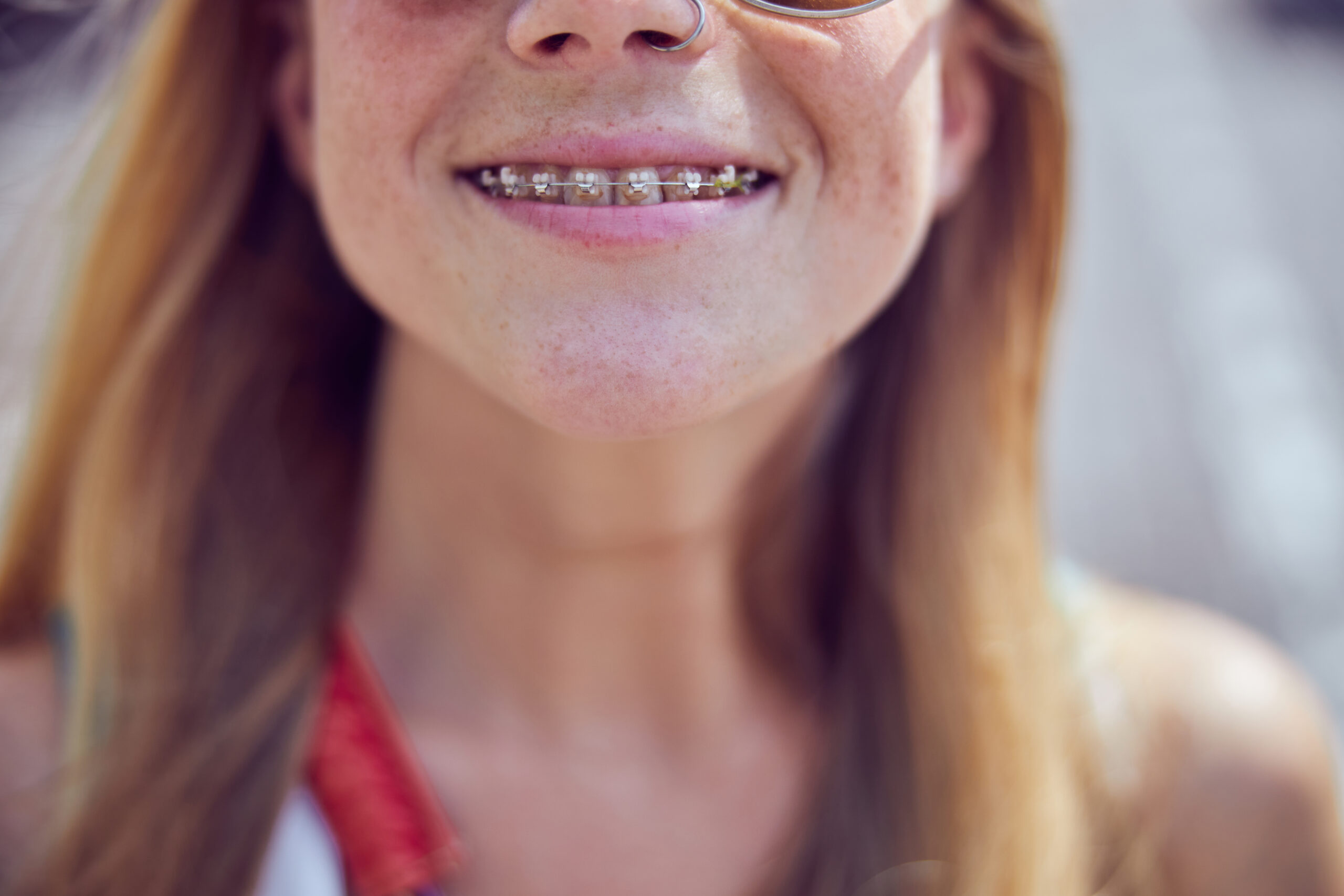 5 Reasons Summer is The Perfect Time For Braces