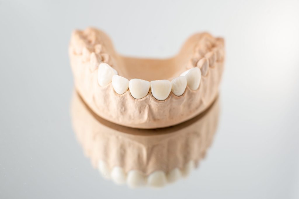 model of artificial jaw with veneers