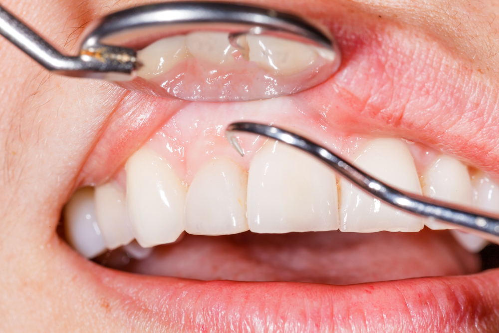 close up of dental contouring procedure